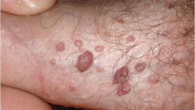 hpv ilk nasıl ortaya çıktı