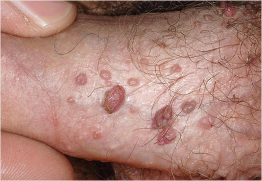 hpv ilk nasıl ortaya çıktı