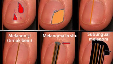 tirnaktaki siyah lekelerin anlami