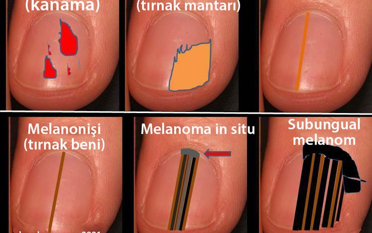 tirnaktaki siyah lekelerin anlami