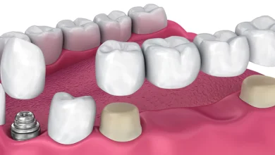 sgk diş köprü fiyatları