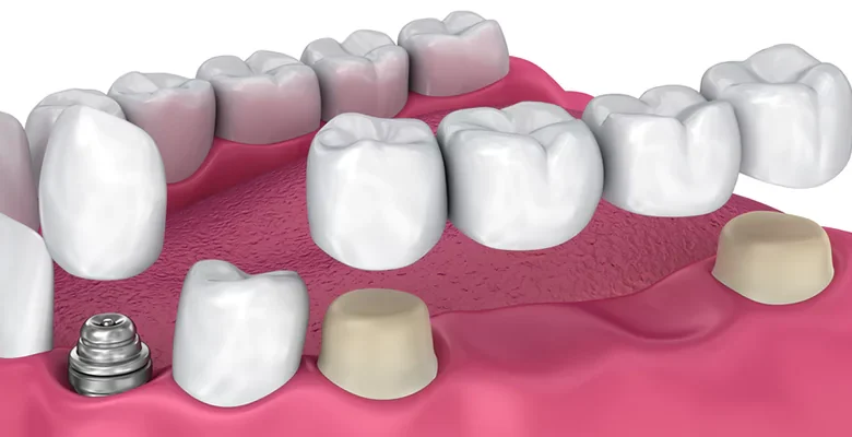sgk diş köprü fiyatları