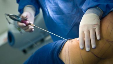 vaser liposuction fiyatları ekşi